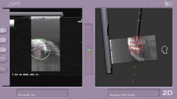 Imagen: El monitor estereoscópicoAIM mostrando la aguja virtual 3D durante la ablación. (Fotografía cortesía de InnerOptic).